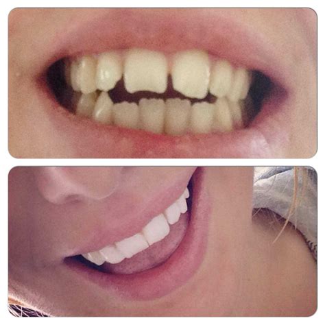 Before And After Dental Composite Bonding My Hollywood Smile Uk
