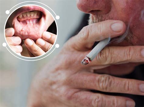 World Oral Health Day 2021 How Tobacco Causes Oral Cancer Onlymyhealth