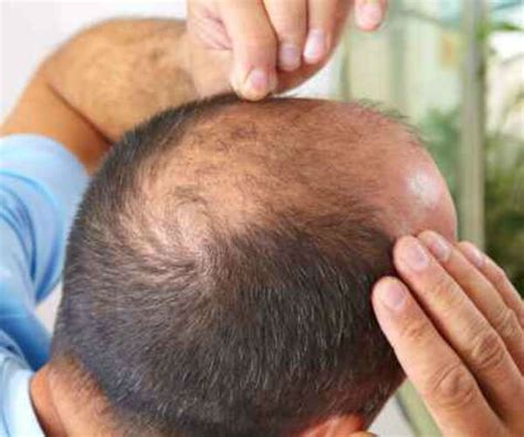 Key Breakthrough In Cure For Baldness