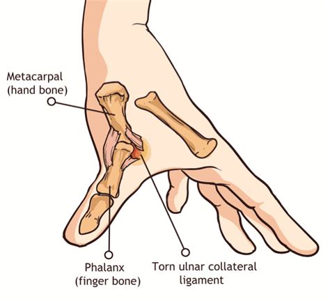 Esguince De Pulgar S Ntomas Causas Tratamiento Con Aparatos Ortop Dicos Para Mu Eca Y Pulgar