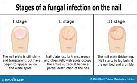 Aggregate More Than 138 Nail Fold Infection Ceg Edu Vn