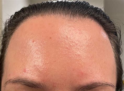 Tiny Bumps On Skin Clogged Pores Or Something Else Skincareaddicts
