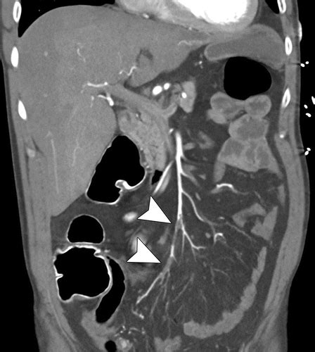 High Value Multidetector Ct Angiography Of The Superior Mesenteric