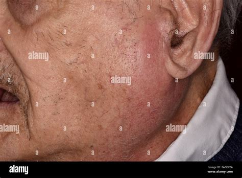 Model Released Inflamed Salivary Gland 92 Year Old Man With Acute