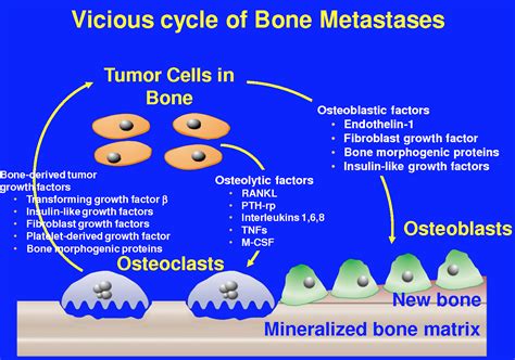 Bone Metastasis Prostate Cancer Pinterest