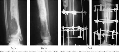 Figure 1 From Limb Salvage For Osteosarcoma Of The Distal Tibia With