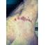 Scabies  Causes Symptoms Treatment Pictures & Images