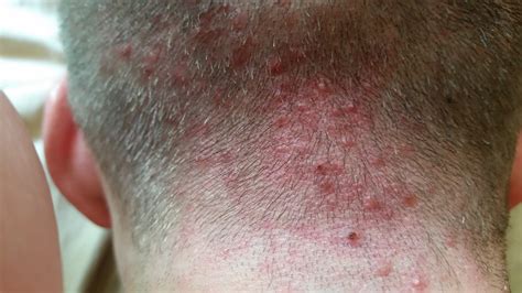 Scalp Bumps Large Bumps On Scalp Red Bumps On My Scalp Itchy Bumps