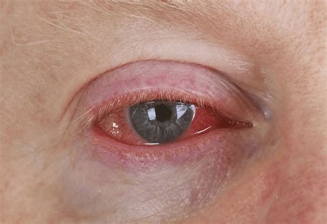 Conjunctivitis Pink Eye Gnm Practitioner