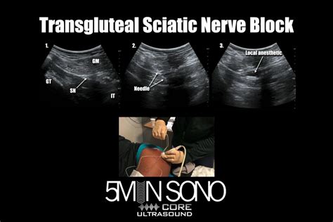 Nerve Blocks Core Ultrasound