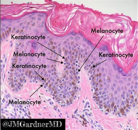 Lentiginous Nevus Perfect Example Of Melanocytes Grey Not Pigmented