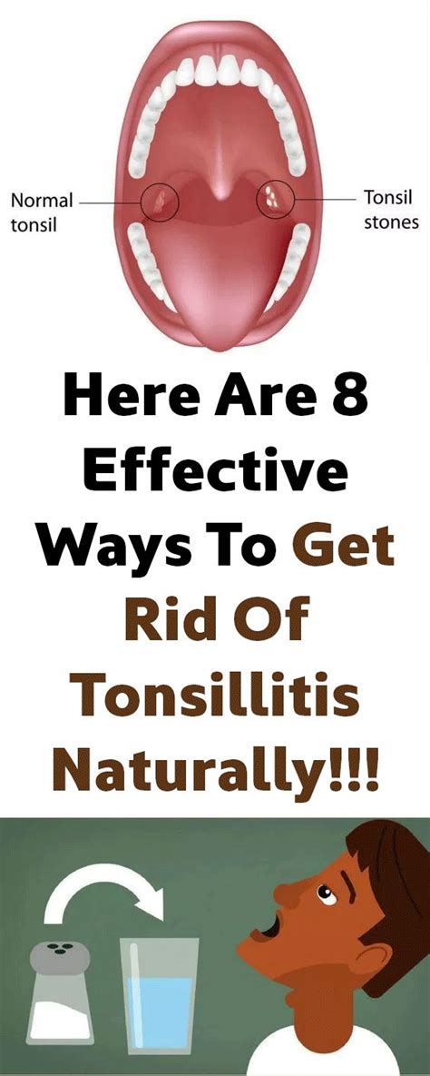 Here Are 8 Effective Ways To Get Rid Of Tonsillitis Naturally