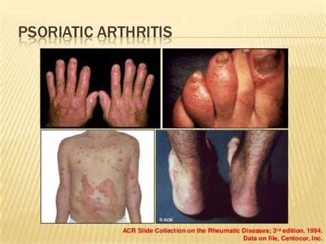 Psoriatic Psoriatic Arthritis Psoriasis Remedies Natural Cure For
