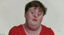 People with facial deformities share their brutally honest experiences ...