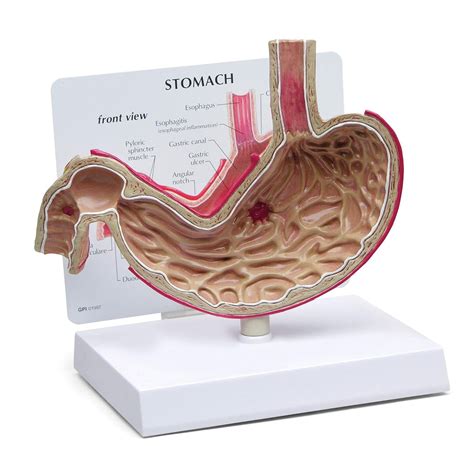 Human Anatomy Model Of Stomach With Ulcers For Anatomy And Physiology Education Anatomy Model