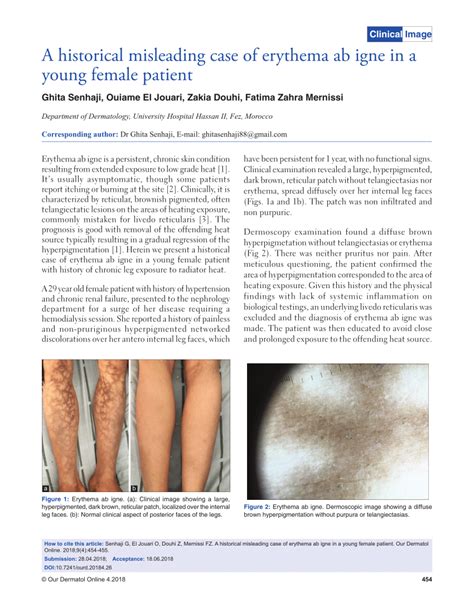 Pdf A Historical Misleading Case Of Erythema Ab Igne In A Young