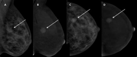 Contrast Enhanced Spectral Mammography Cesm Mediolateral Oblique