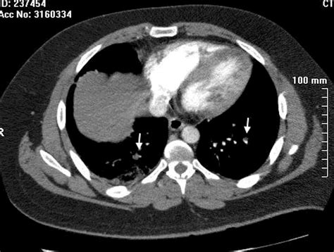 Patient With Subsegmental Pulmonary Embolism Computed Tomography Download Scientific Diagram