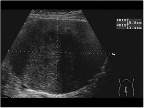 Ovarian Thecoma Ultrasound