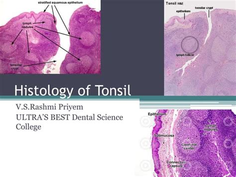 White Patch On The Tonsil Differential Diagnosis