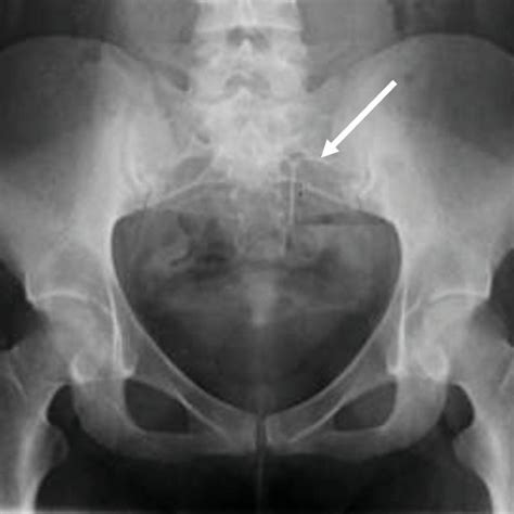 Plain Radiography Of Pelvis Iud Dislocation Is Noted On The Left