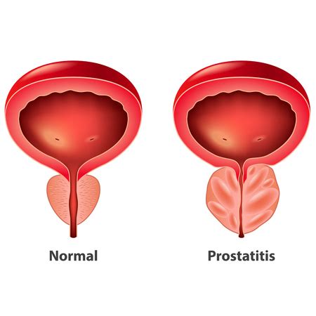 Explains prostate problems including prostatitis and benign prostatic hyperplasia. Inflamación de la próstata ¿Síntoma de alarma? ⚠️