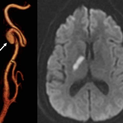 Right Cervical Internal Carotid Artery Ica Dissecting Pseudoaneurysm