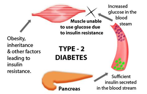 Type 2 Diabetes Diabetes Innovation Management