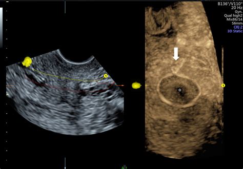 Threedimensional Ultrasound Imaging Of Intraabdominal Cervical