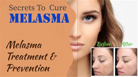 Melasma Treatment And Prevention Best Melasma Treatment How To Get