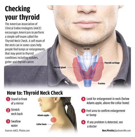 Thyroid Issues Check Out Your Eyes Really Yes The Thyroid
