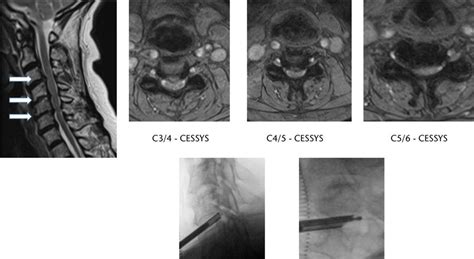Bilateral Foraminal Stenosis C5 C6 Health Checklist