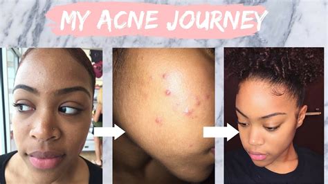 My Acne Journey How I Cleared My Skin Using Tretinoin Youtube