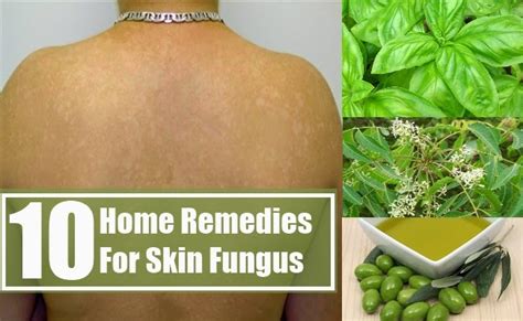10 Home Remedies For Skin Fungus ~ Mzizi Mkavu