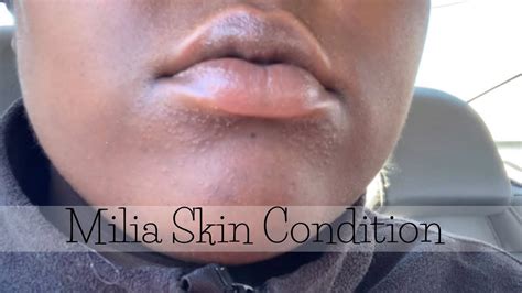 I Developed A Skin Condition Called Milia 2 Day Treatment 2019