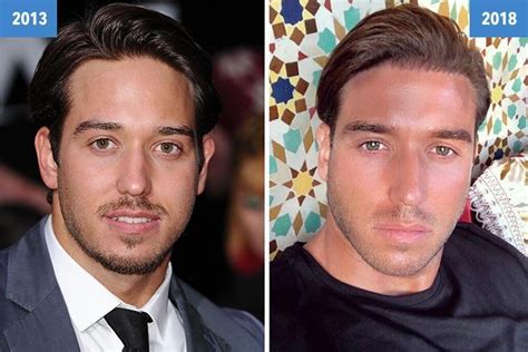 James Lock Looks Dramatically Different Five Years After Joining Towie Following Hair Transplant