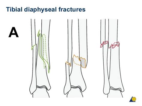 2016 Icd 10 Code For Fractured Proximal Fibula