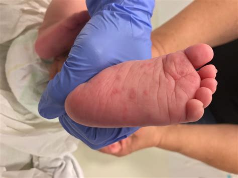 Itchy Rash On Hands And Feet Clinical Advisor