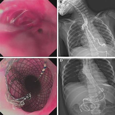 The Nitinol Fully Covered Self Expandable Metal Stents FCSEMS The