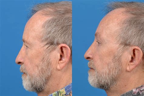Patient 122406284 Male Neck Lift Before And After Photos Clevens Face