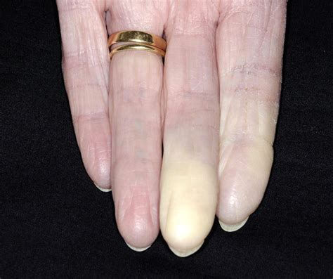 Diagnosis And Management Of Raynauds Phenomenon The Bmj