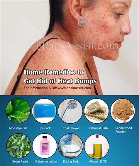 Causes Of Heat Bumps Amp Home Remedies To Get Rid Of It Riset
