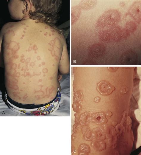 Erythema Multiforme Dermatology Oasis Images