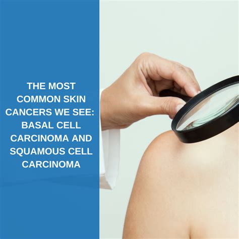 Most Common Skin Cancers Savannah River Dermatology