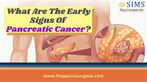 What Are The Early Signs Of Pancreatic Cancer Pancreatic Cancer Treatment In Chennai Dr