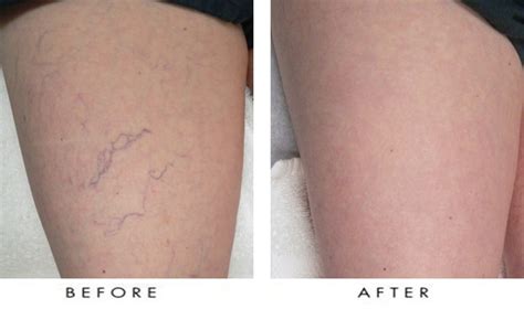 What Is The Best Way To Treat Spider Veins Dr Shel Wellness