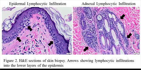 Cutaneous Epitheliotrophic Lymphomamycosis Fungoides In Dogs Clinical