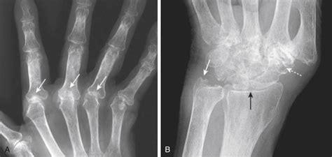 Hand Rheumatoid Arthritis Musculoskeletal Key