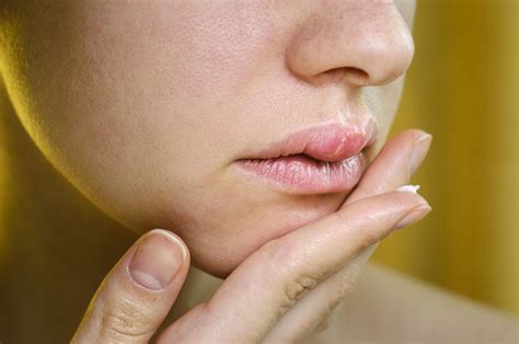 Staph On Lips Causes Symptoms And Treatment