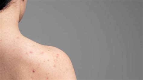 Les Symptômes Et Le Traitement De La Dermatite Séborrhéique Mdhp